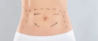 Possible risks of abdominoplasty and how to avoid them