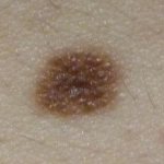 Congenital small melanocytic nevus