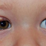 Ячмень на глазу у ребенка (верхнее или нижнее веко)
