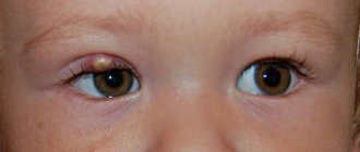 Ячмень на глазу у ребенка (верхнее или нижнее веко)