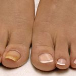 Желтые ногти на одной ноге у женщины